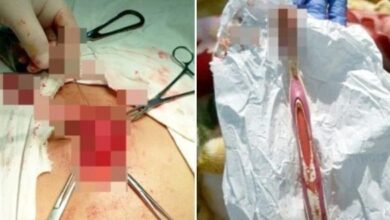 Photo of Paciente passa por cirurgia após engolir uma escova de dentes