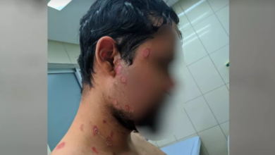 Photo of Homem diz que sofreu queimaduras ao fritar coxinha congelada que explodiu e voou como ‘foguete’, em Goiânia