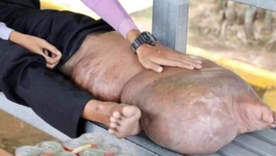 Photo of Picadas de mosquito deixam homem com perna igual a de elefante