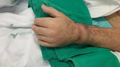 Photo of Homem tem mão reimplantada após preservá-la igual em seriado de TV