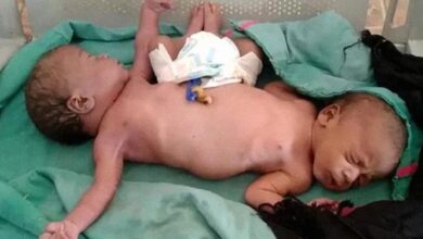 Photo of Gêmeas siamesas nascem com duas pernas e quatro braços