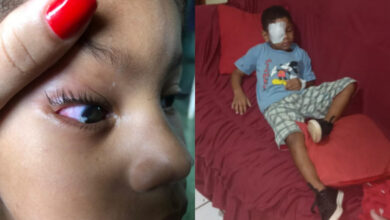 Photo of ​Criança que teve olho perfurado por palito de churrasco realiza cirurgia e passa bem