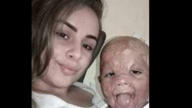 Photo of Menino com 100% do rosto queimado arrecada R$ 40 mil para ‘virar’ herói