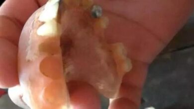 Photo of Dentes de ouro de vítima de Covid-19 são furtados em hospital
