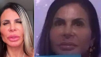 Photo of Gretchen mostra resultados uma semana após harmonização facial