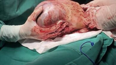 Photo of Em fenômeno raro, Santa Casa registra nascimento de gêmeo dentro da bolsa amniótica da mãe