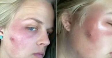 Photo of Mulher vai parar no hospital após tentar estourar espinha