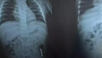 Photo of Marabá: criança de 1 ano é internada após engolir prego