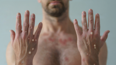 Photo of Belém registra primeira morte por Monkeypox