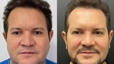 Photo of Ximbinha passa por harmonização facial e compartilha resultado com fãs