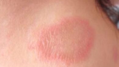 Photo of Pará registra 1.486 novos casos de hanseníase em 2025; Belém concentra maior número de notificações