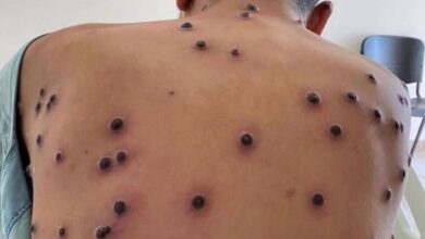 Photo of OMS identifica nova variante recombinante de mpox no Reino Unido e na Índia