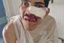 Photo of Pam Pam é transferido para Hospital Metropolitano e pode passar por cirurgia após atropelamento